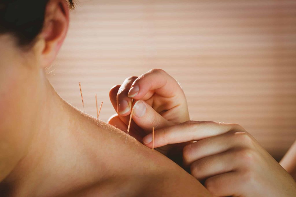 Acupuncture - Drug-free pain management